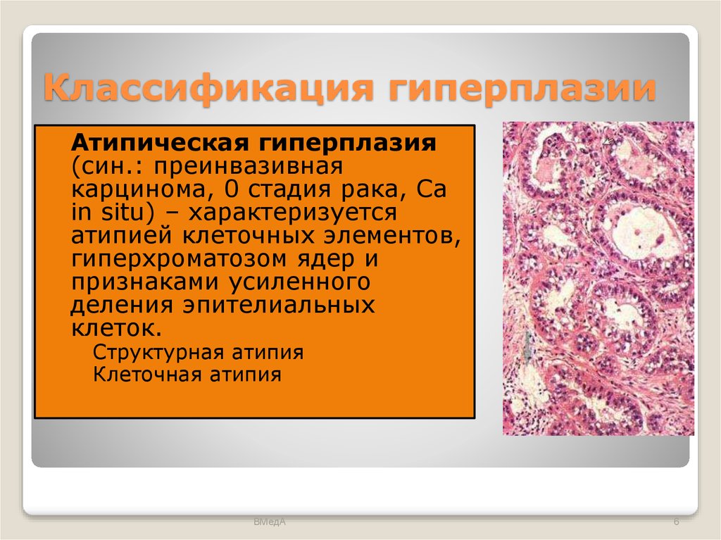 Гиперплазия переходит в рак. Атипическая гиперплазия. Атипическая гиперплазия эндометрия. Железистая атипическая гиперплазия. Гиперплазия классификация.