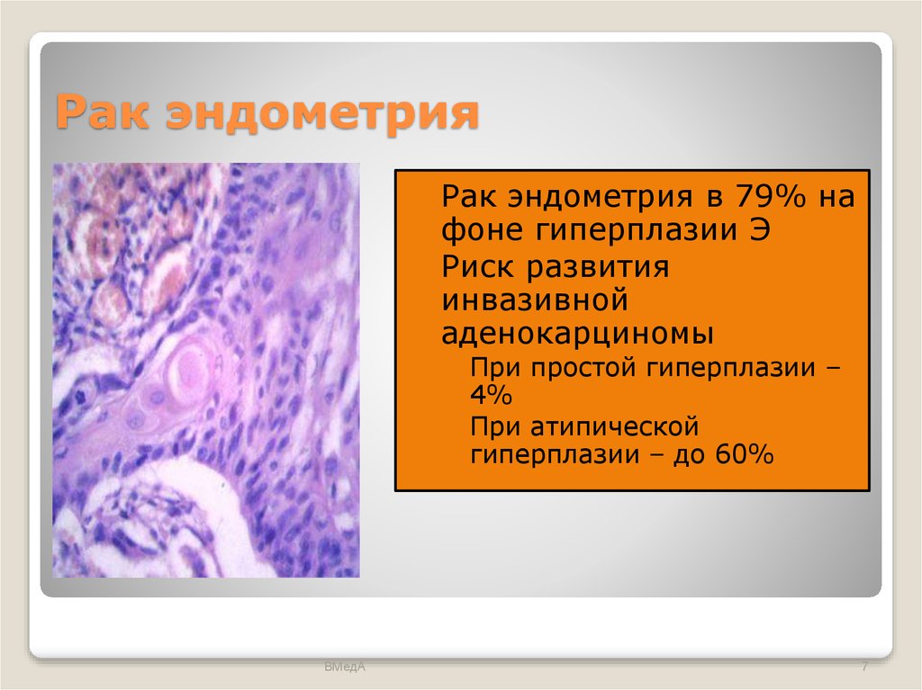 Гиперплазия переходит в рак. Гиперплазия эндометрия ppt. Гиперплазия эндометрия это онкология ?. Аденокарцинома g2 эндометрия. Аденокарцинома эндометрия презентация.
