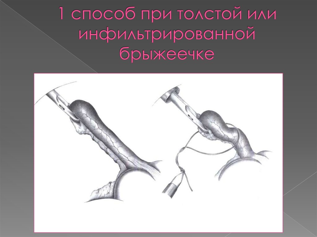 1 способ при толстой или инфильтрированной брыжеечке