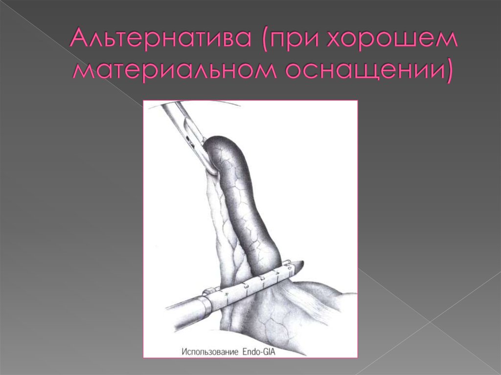 Альтернатива (при хорошем материальном оснащении)