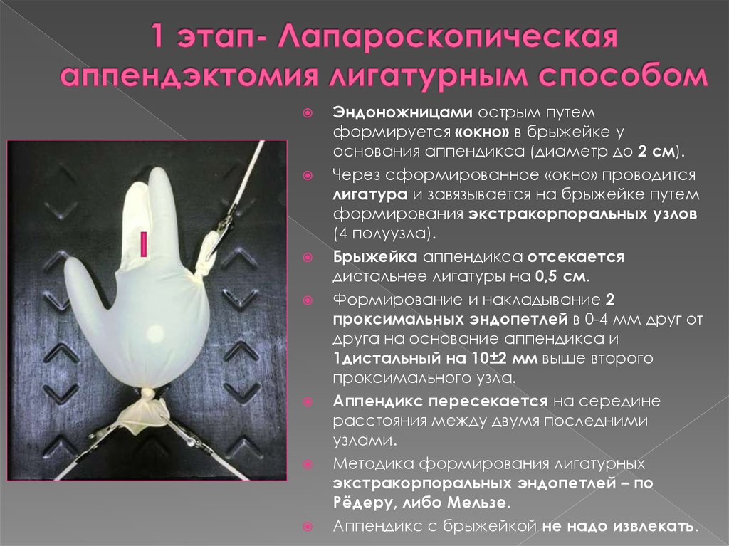 1 этап- Лапароскопическая аппендэктомия лигатурным способом