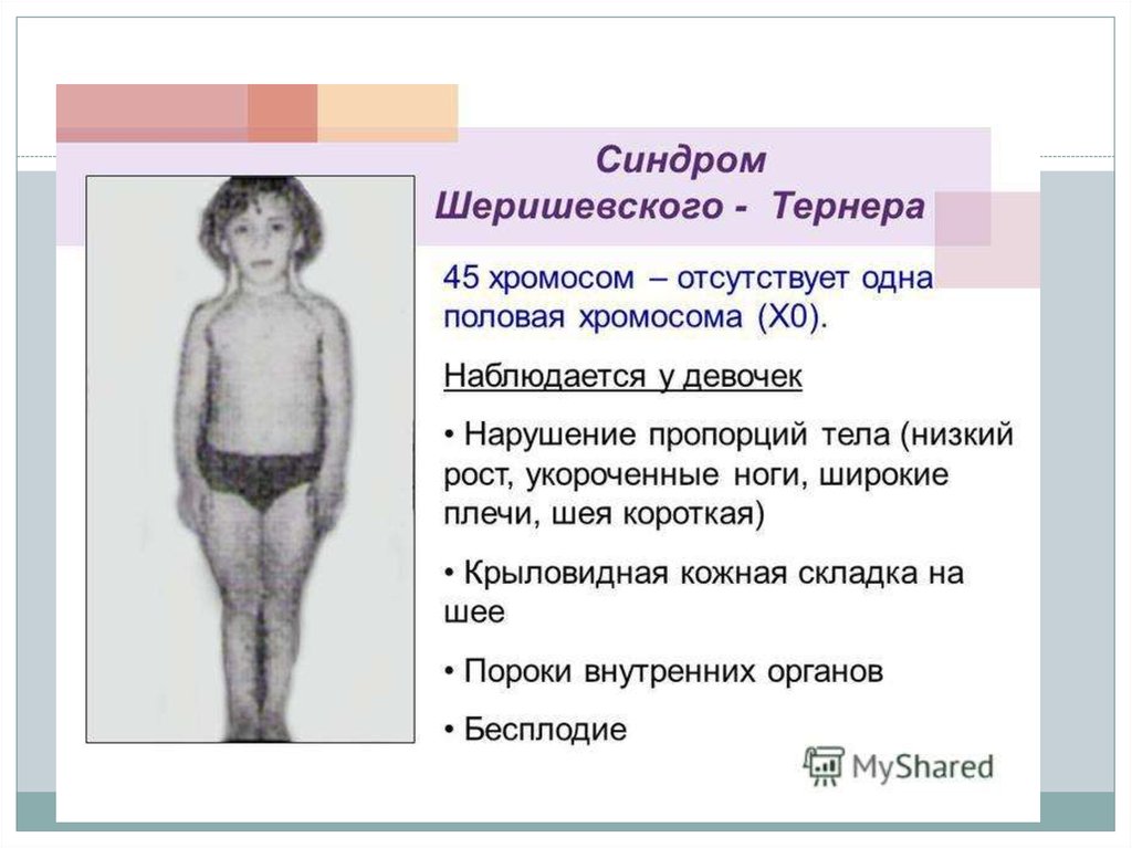 Синдром тернера какая хромосома. Одна половая хромосома х. Евнухоидные пропорции тела. Евнухоидный Тип телосложения у женщин.