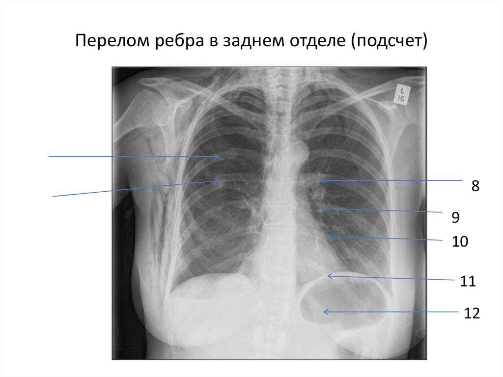 9.8 10. Перелом 9 10 11 ребра слева рентгенограмма. Перелом 5 ребра слева рентген. Рентген перелом 11 ребра. Перелом 9 ребра слева рентген.