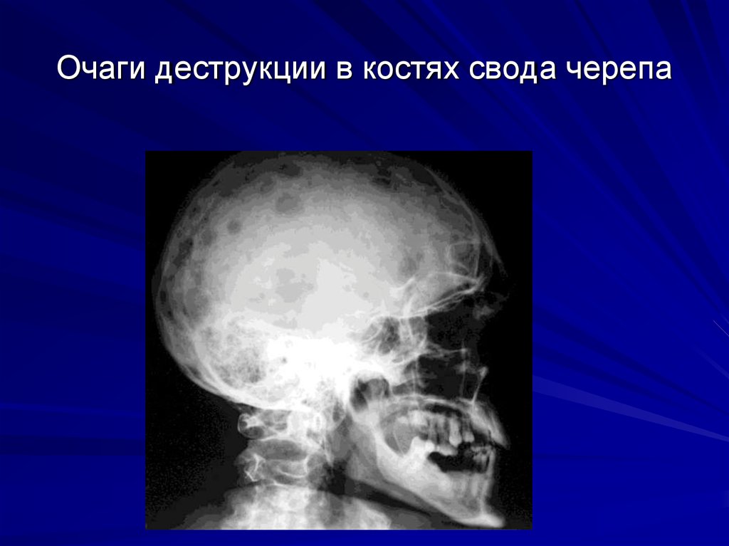 Очаговые изменения костей. Метастазы в кости черепа на рентгене. Деструкция костей миеломная болезнь. Миеломная болезнь кости черепа. Остеопороз костей свода черепа.