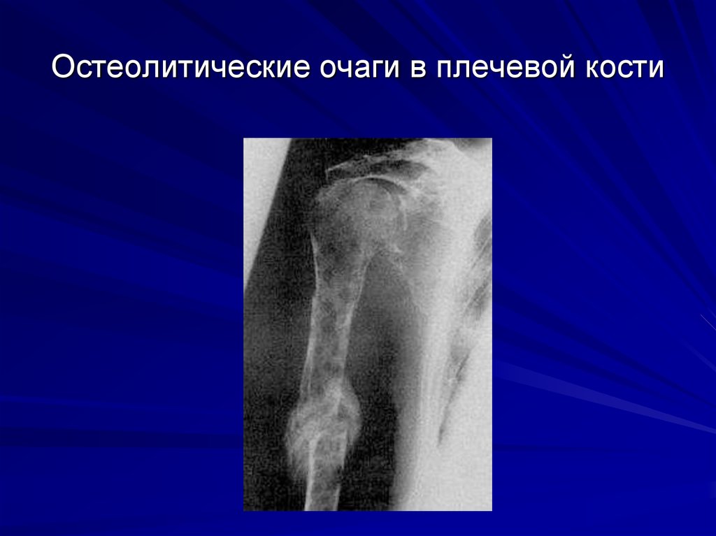 Очаговые изменения костей. Остеолитическая деструкция кости что это. Остеолитические метастазы рентген. Остеолитические метастазы в кости. Рентгенодиагностика остеобластических метастазов.