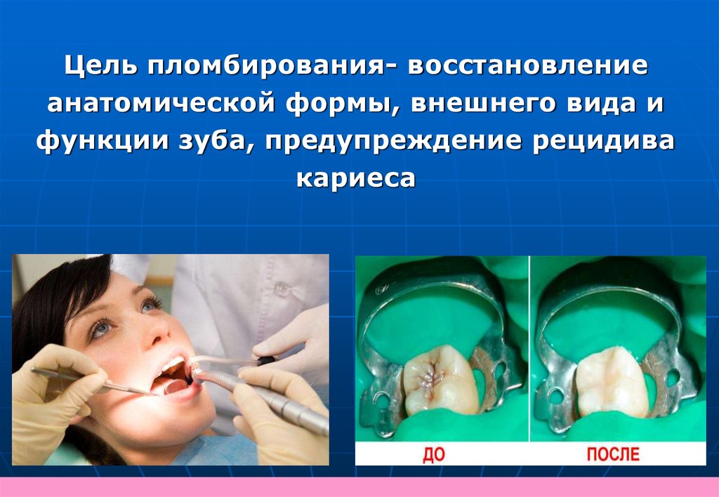 Техника замешивания и хранение стоматологических материалов ...