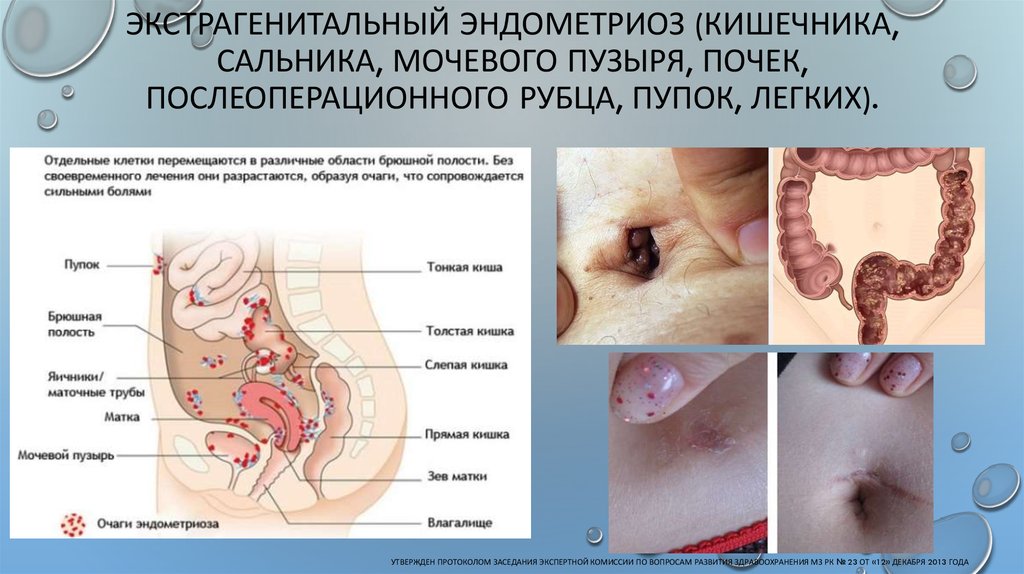 Экстрагенитальный эндометриоз (кишечника, сальника, мочевого пузыря, почек, послеоперационного рубца, пупок, легких).