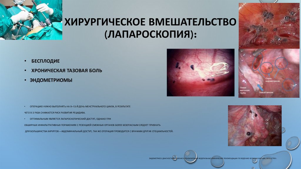 Хирургическое вмешательство (лапароскопия):
