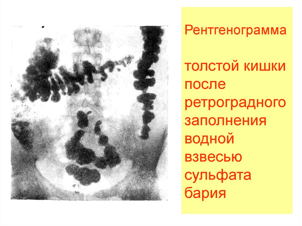 После бария. Ретроградное заполнение кишки. Толстая кишка после бария.