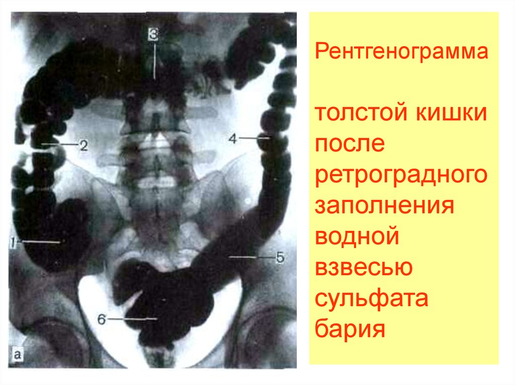 Контраст кишечника. Контрастная рентгенография толстой кишки. Патологии сигмовидной кишки на рентгене. Сигмовидная кишка рентген анатомия. Ретроградная рентгенография Толстого кишечника.