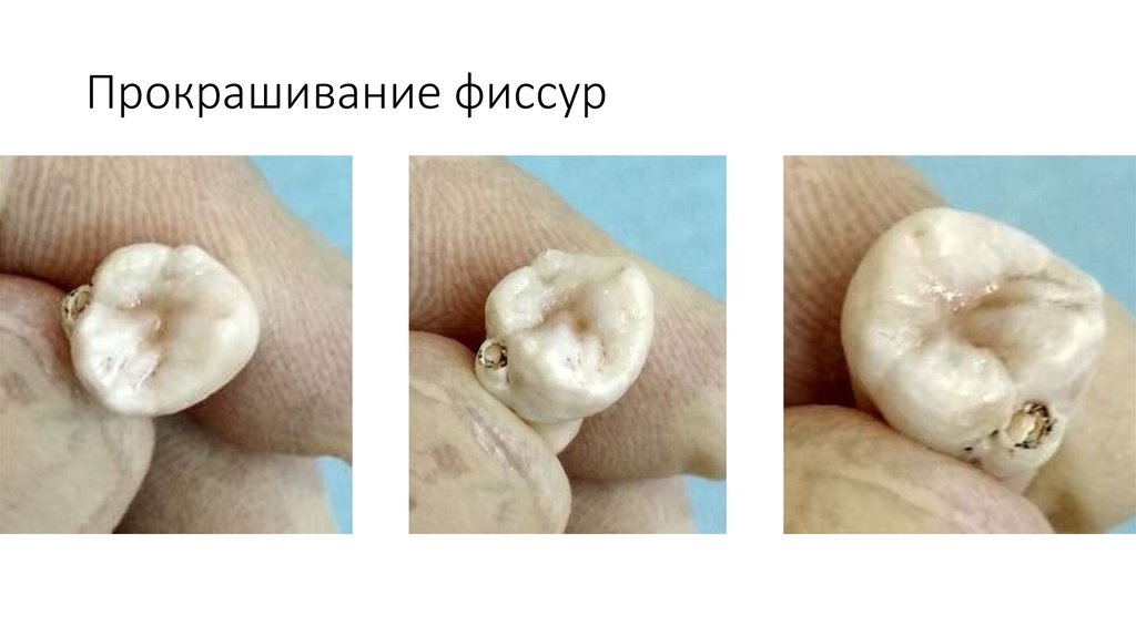 Прокрашивание фиссур