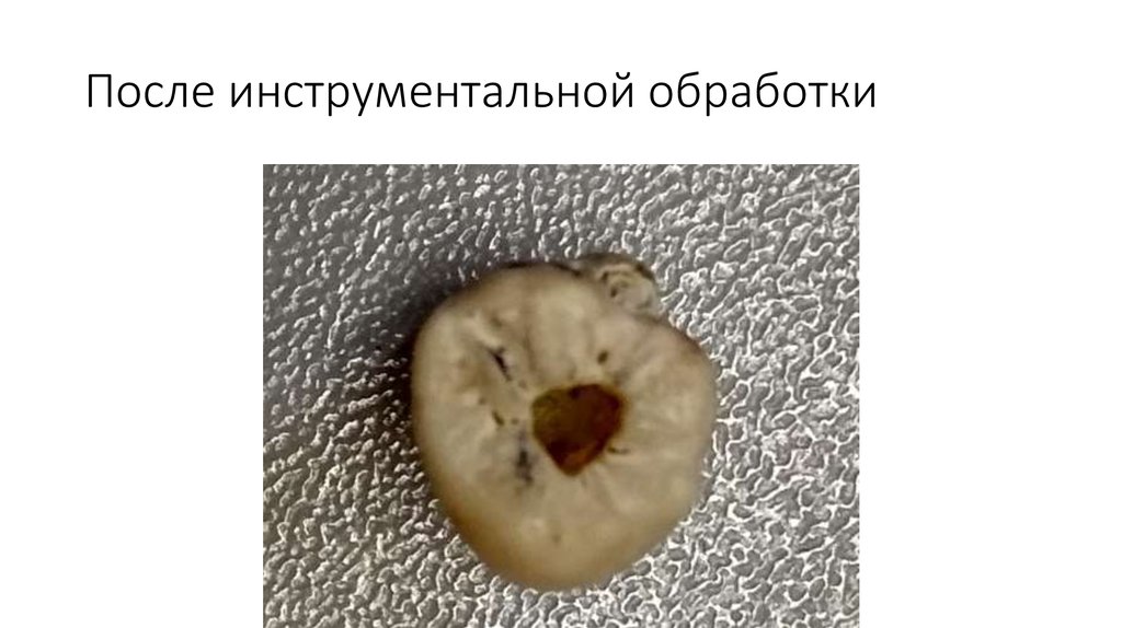 После инструментальной обработки