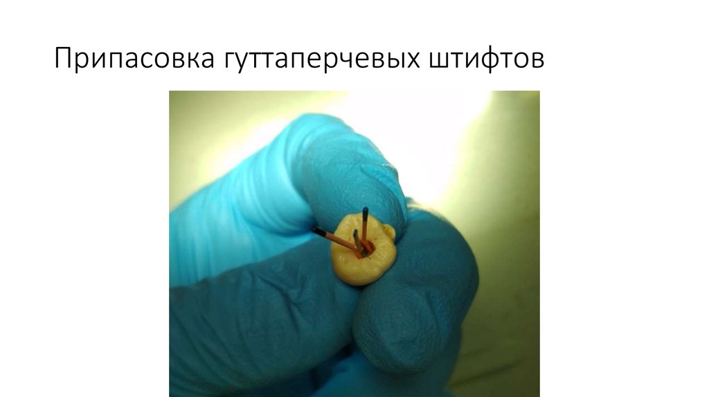 Припасовка гуттаперчевых штифтов
