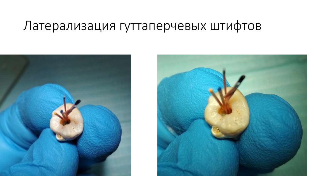 Латерализация гуттаперчевых штифтов