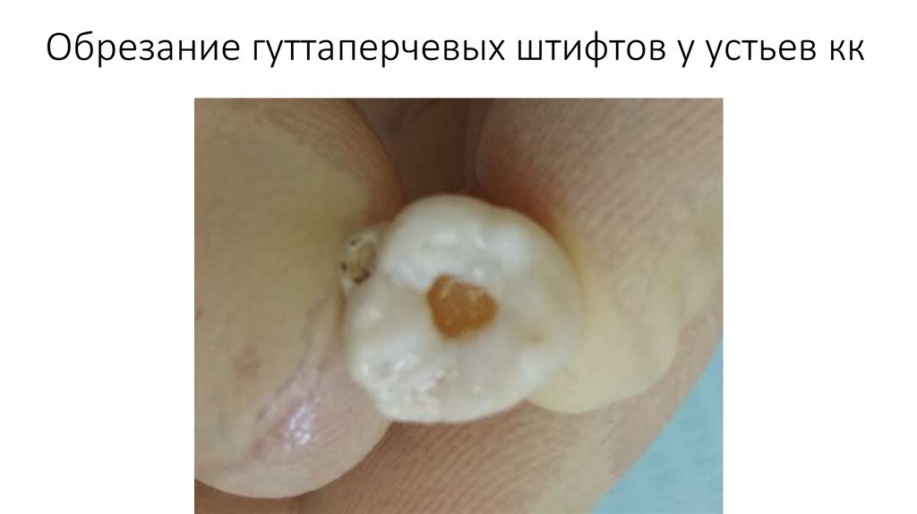 Обрезание гуттаперчевых штифтов у устьев кк