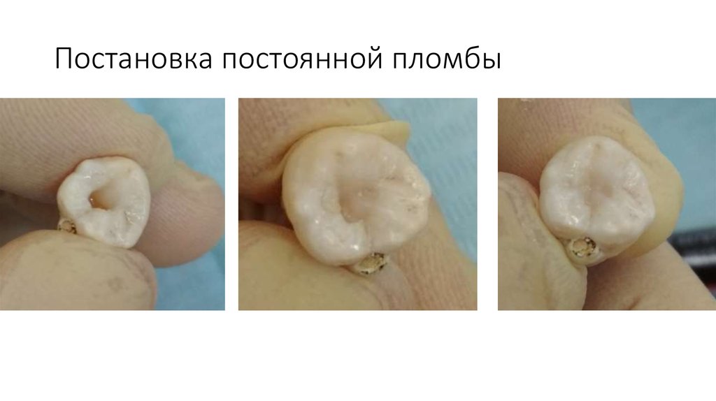 Постановка постоянной пломбы