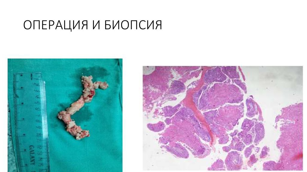 ОПЕРАЦИЯ И БИОПСИЯ