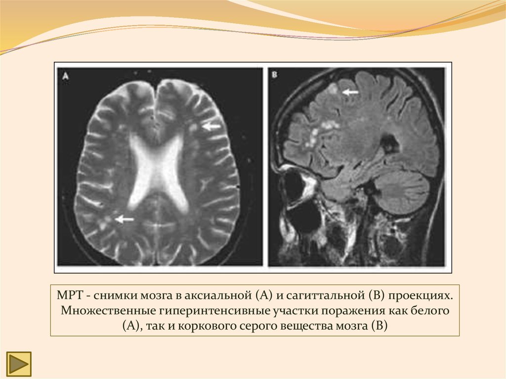 Рассеянный склероз очаги в головном. Рассеянный склероз на мрт головного мозга. Мрт рассеянного склероза. Мрт головного мозга при рассеянном склерозе. Мрт при рассеянном склерозе заключение.