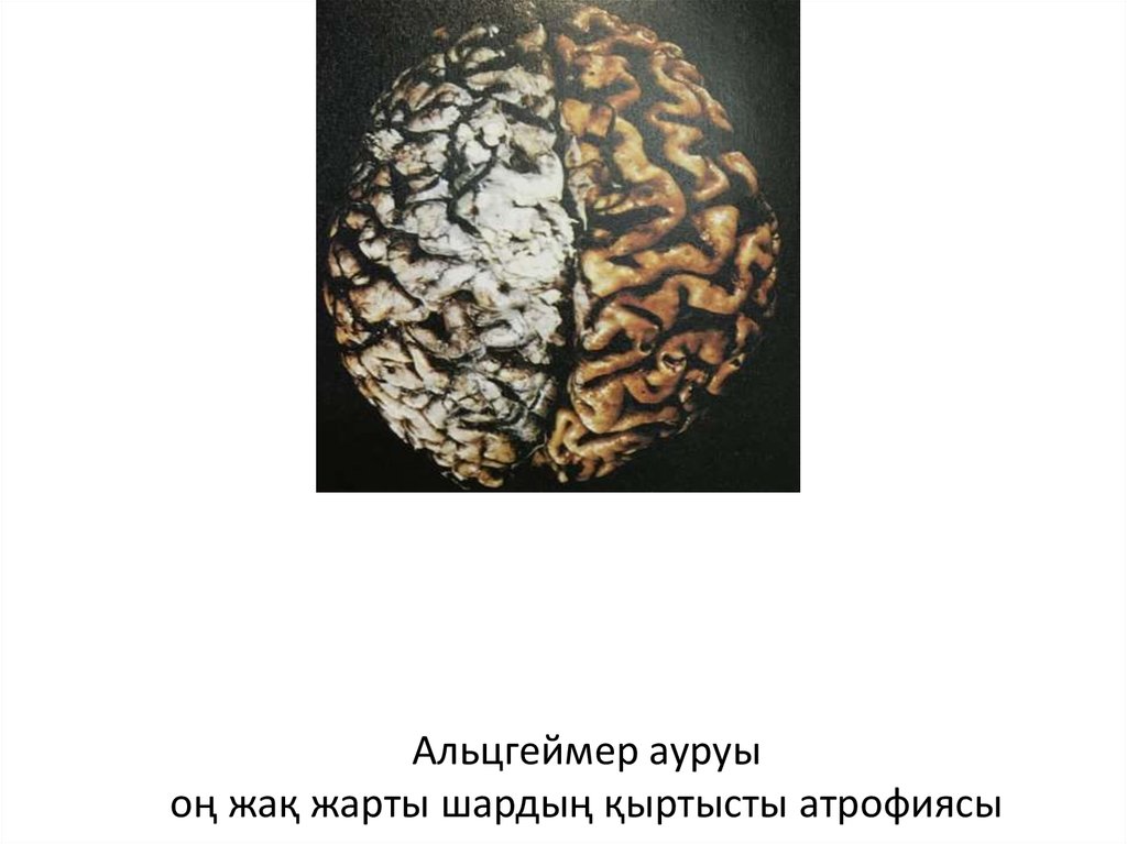 Альцгеймер ауруы оң жақ жарты шардың қыртысты атрофиясы