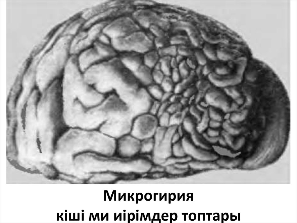 Микрогирия кіші ми иірімдер топтары