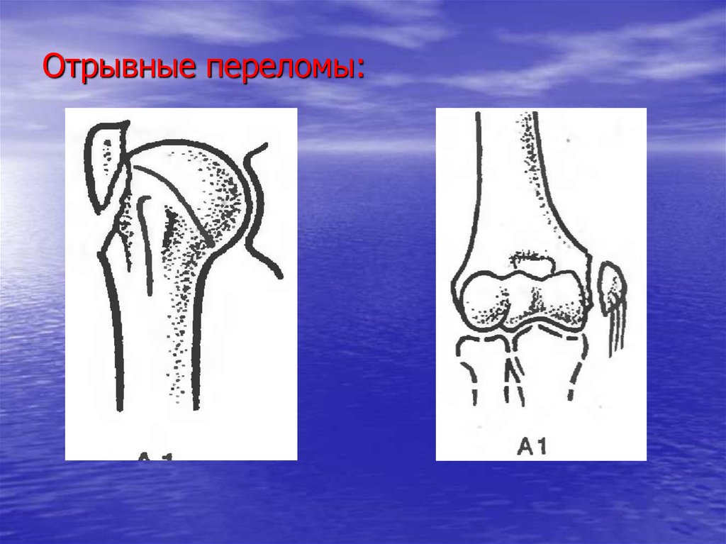 Перелом бедренного вертела