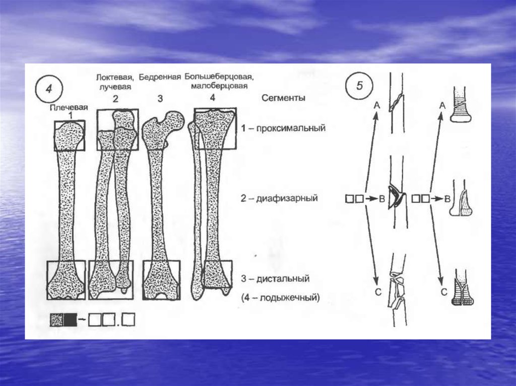 Переломы трубчатых костей. Дистально и проксимально это. Проксимальный и дистальный. Переломы трубчатой кости клиническая картина. Проксимальный дистальный сегмент.