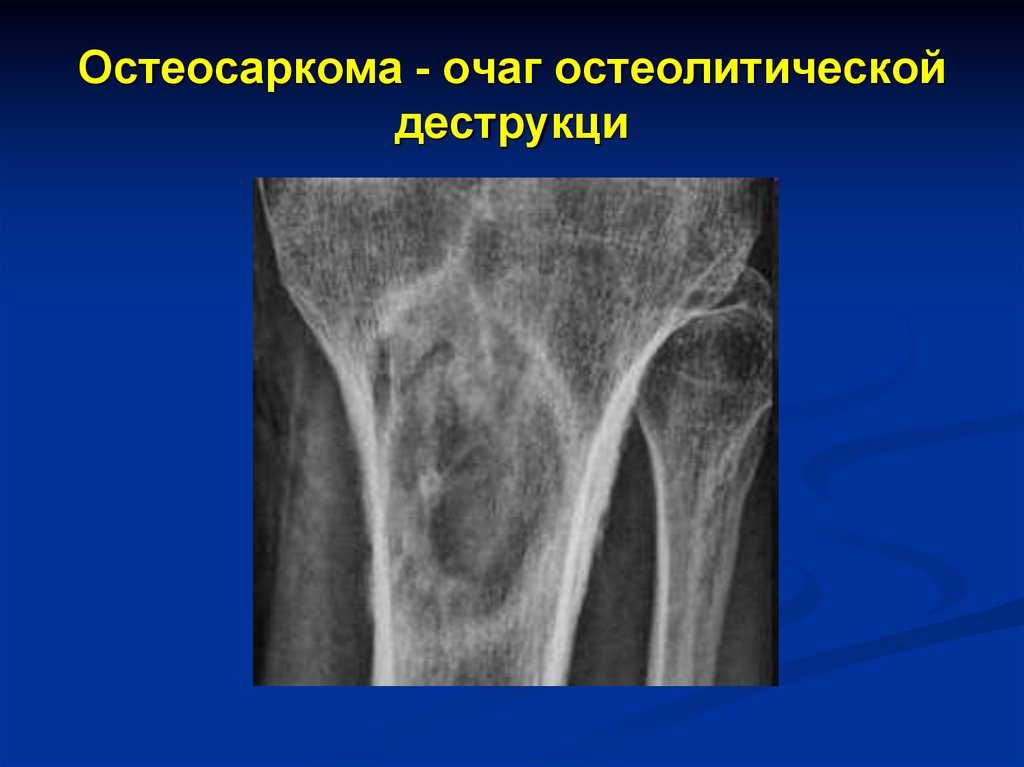 Метастатическое поражение костей. Остеолитическая остеосаркома. Остеосаркома остеобластическая форма. Остеолитическая деструкция кости что это. Остеогенная остеолитическая саркома.