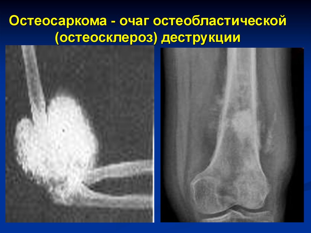 Остеосаркома. Остеобластическая остеосаркома рентген. Остеобластическая остеогенная саркома рентген. Остеобластическая остеогенная саркома плечевой кости. Остеосклероз плечевой кости на рентгене.