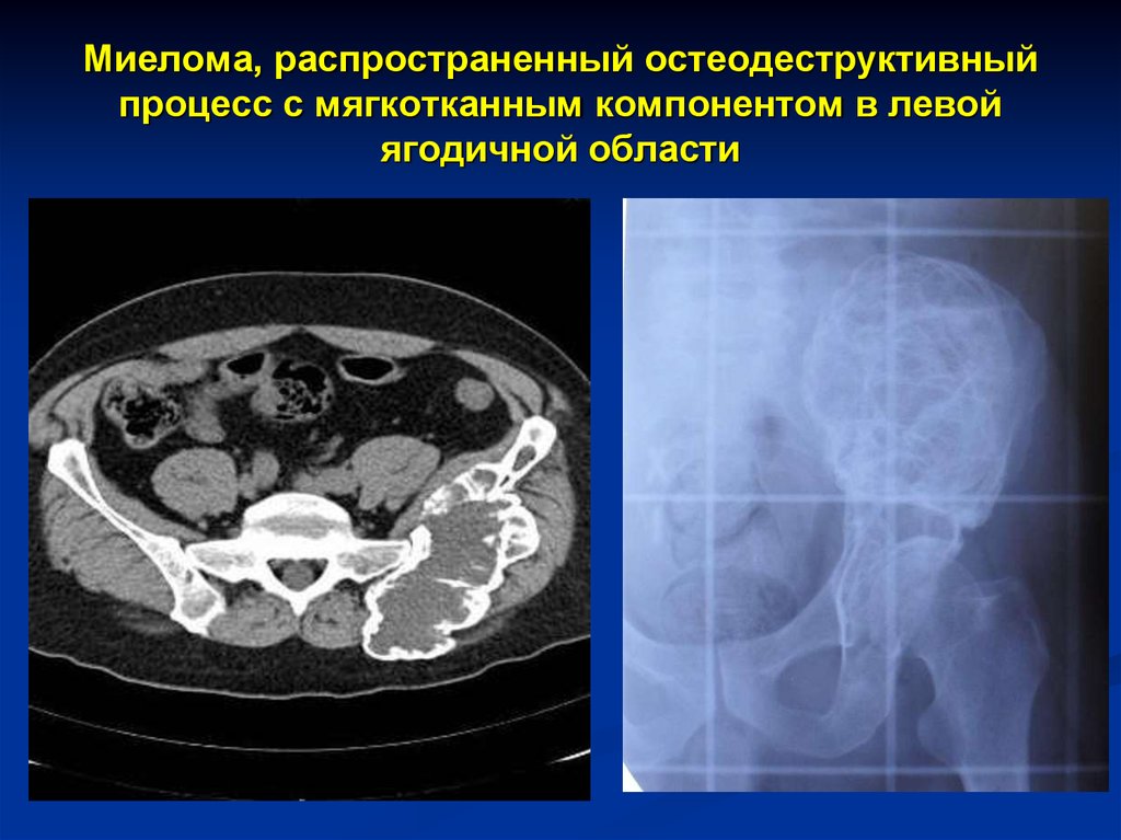 Мягкотканное образование в легком на кт. Миеломная болезнь на кт костей. Миелома костей черепа на кт. Миеломная болезнь на кт черепа.