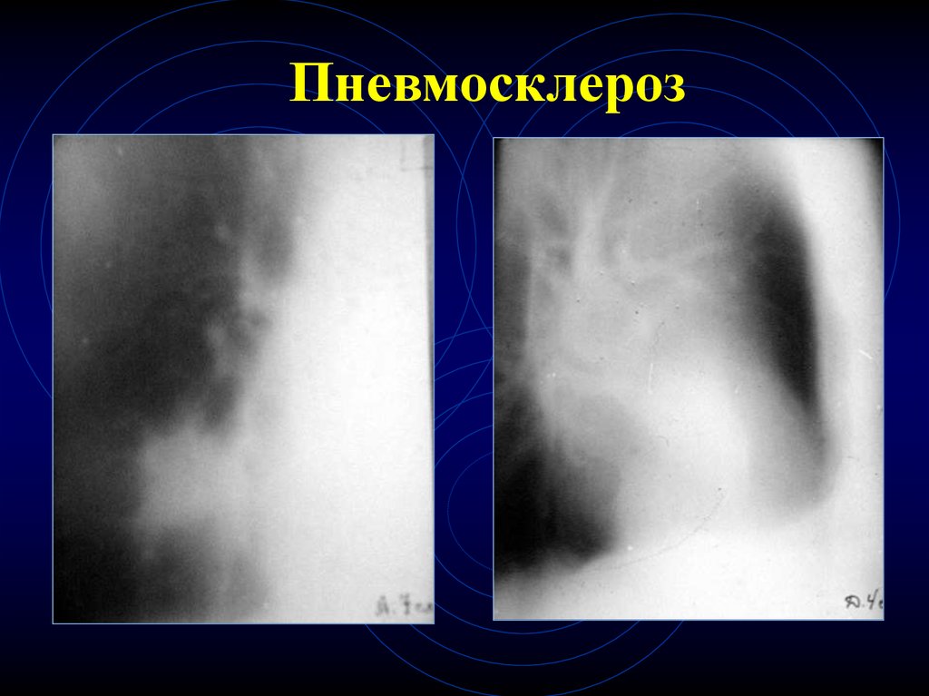 Пневмосклероз это простыми словами. Пневмосклероз рентген. Пневмосклероз рентгенограмма. Альвеолярный пневмосклероз. Интерстициальный пневмосклероз.