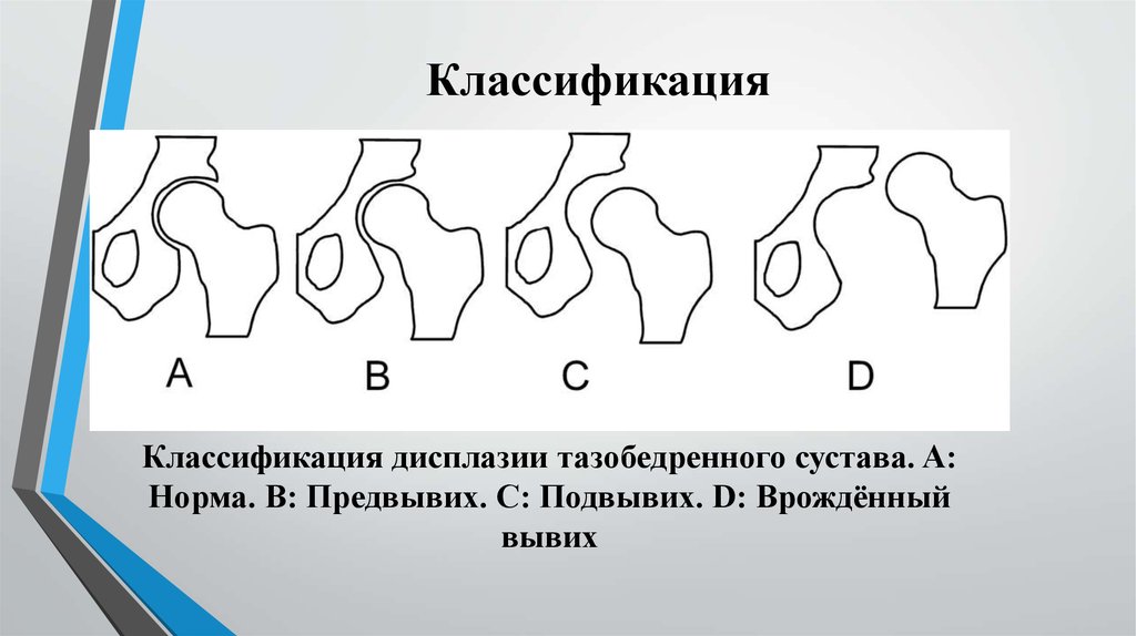 Врожденный вывих бедра. Подвывих тазобедренного сустава классификация. Подвывих тазобедренного сустава кла. Классификация дисплазии тазобедренных суставов. Врожденный вывих бедра классификация.