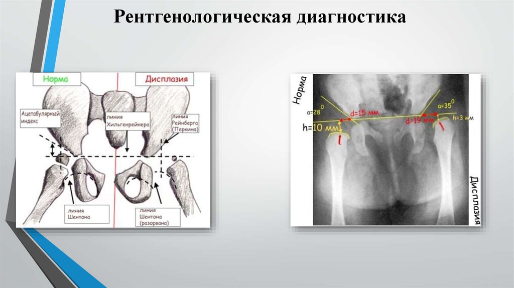 Вывих бедра презентация