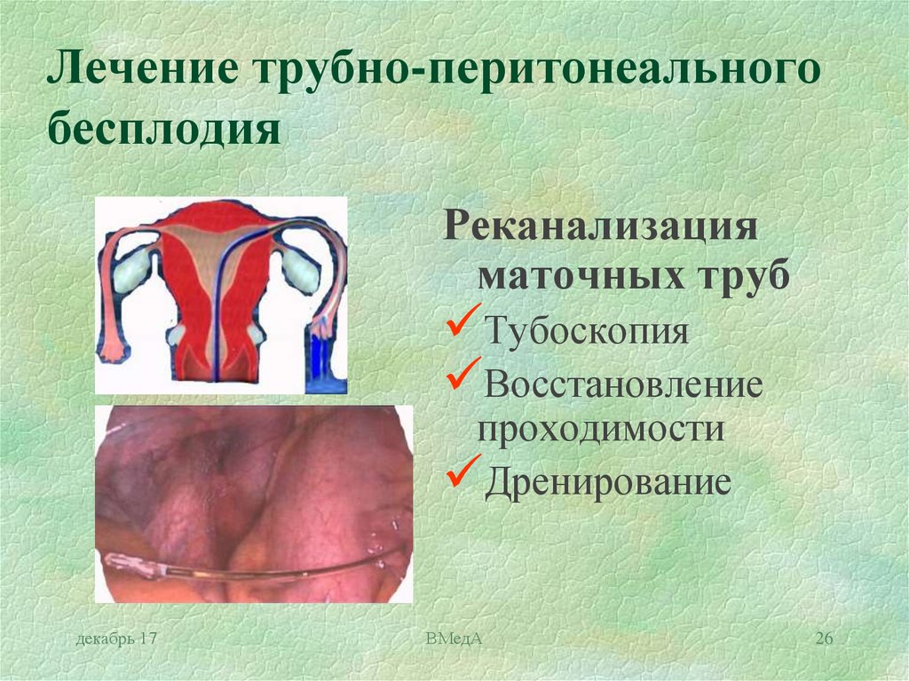 Трубное бесплодие картинки