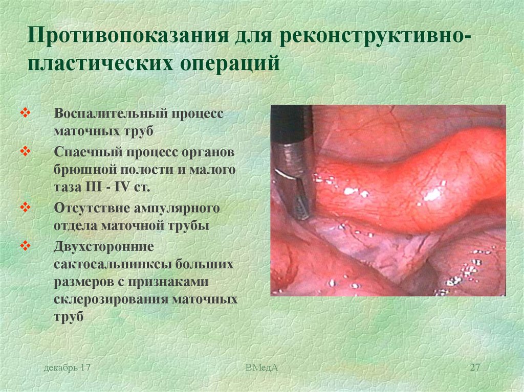Лечение трубно-перитонеального бесплодия