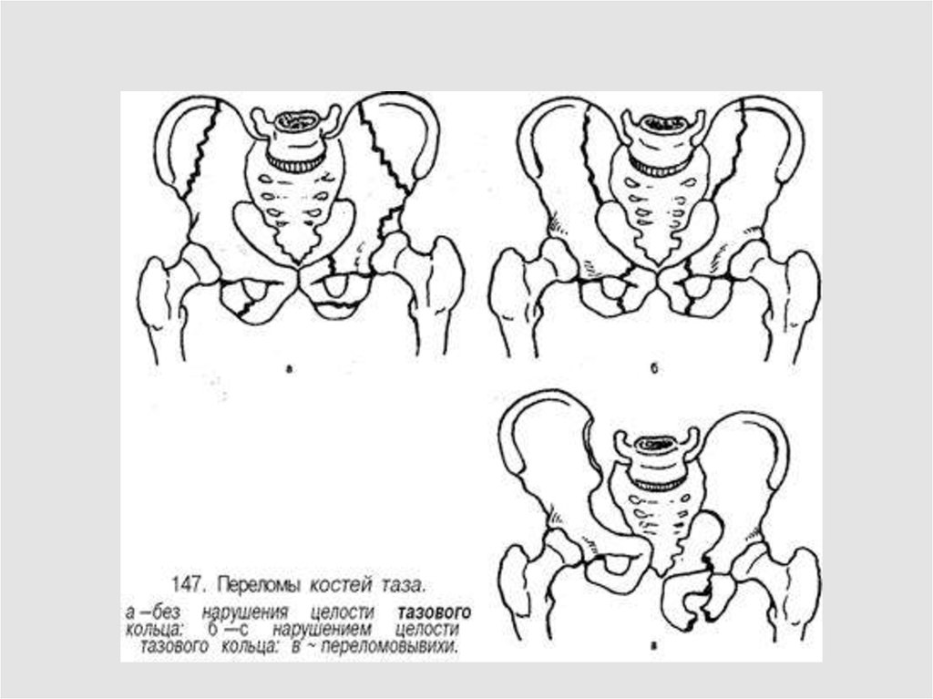 Травма таза картинки
