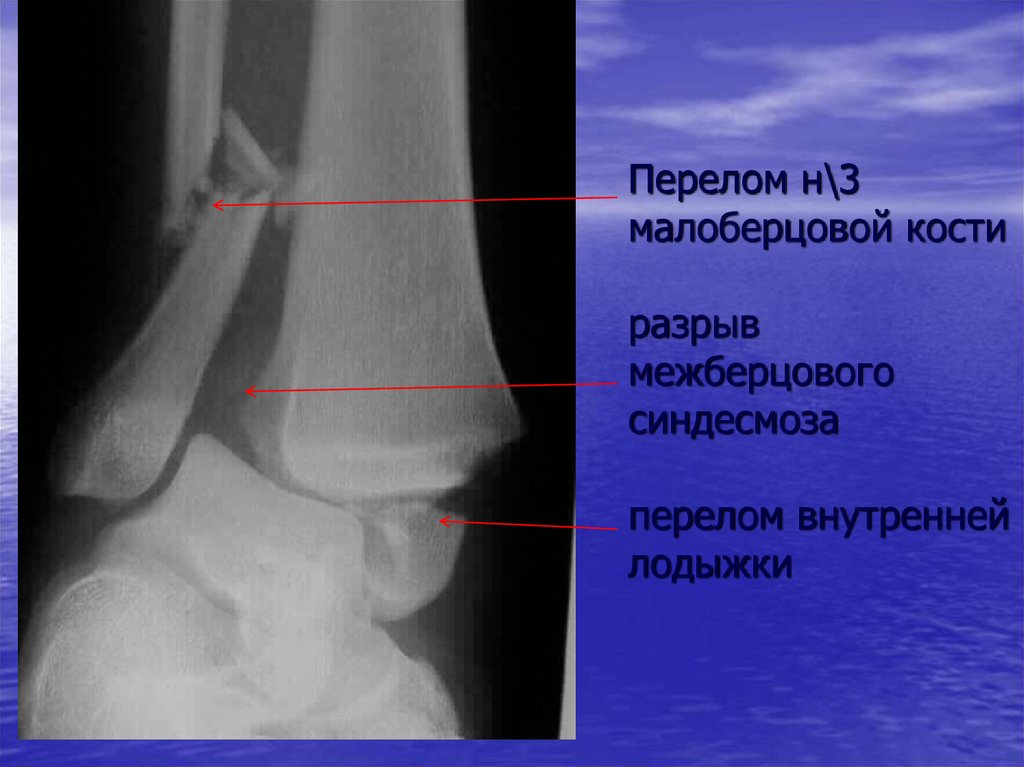Перелом н 3. Перелом метаэпифиза малоберцовой кости. Краевой перелом малоберцовой кости. Разрыв дистального межберцового синдесмоза рентген.