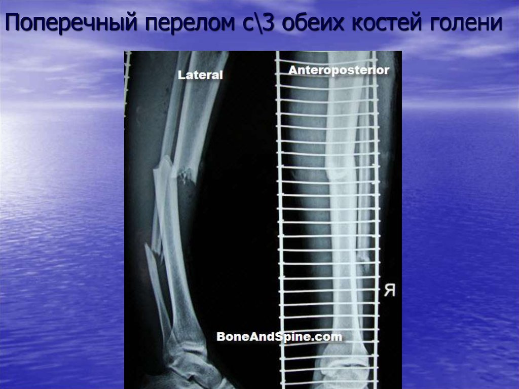 Перелом н 3. Поперечный перелом голени. Поперечный перелом голени рентген. Перелом обеих костей голени. Рентгеноанатомия костей голени.