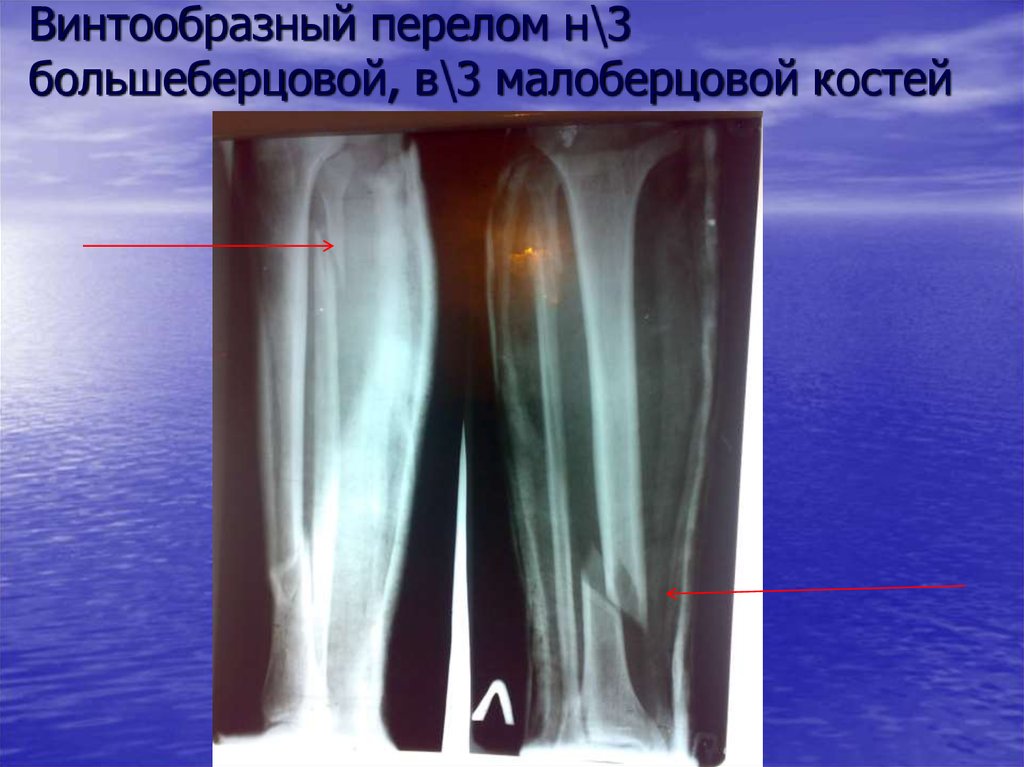 Перелом н 3. Перелом диафиза малоберцовой кости рентген. Перелом малоберцовой кости. Перелом диафиза костей голени рентген. Перелом диафиза большеберцовой кости.