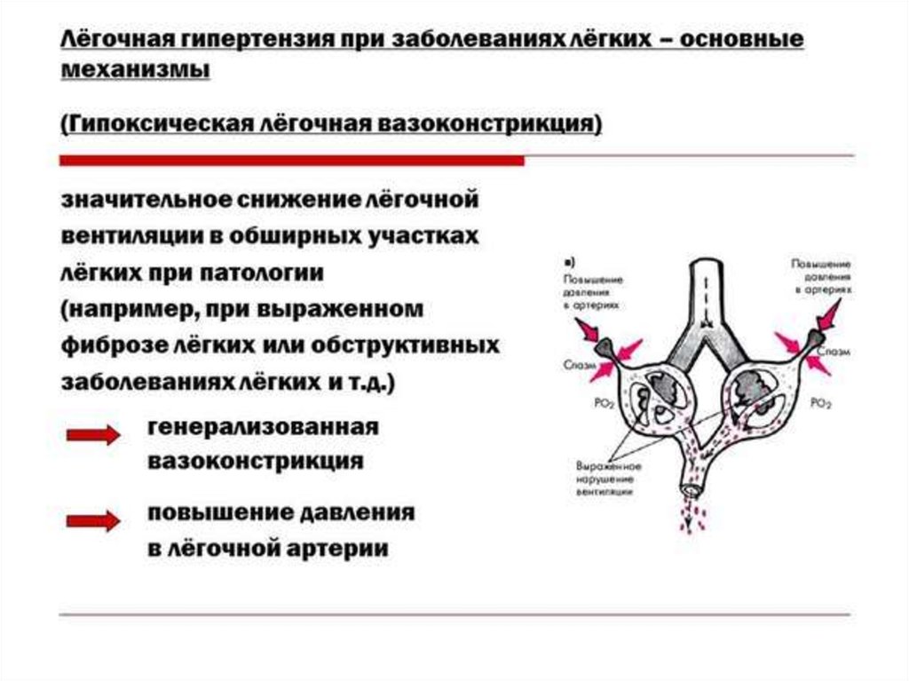 Легочная ситуация. Первичная легочная гипертензия схема. Причины и механизмы развития вторичной легочной гипертензии. Причины повышения легочного давления. Легочная гипертензия при.