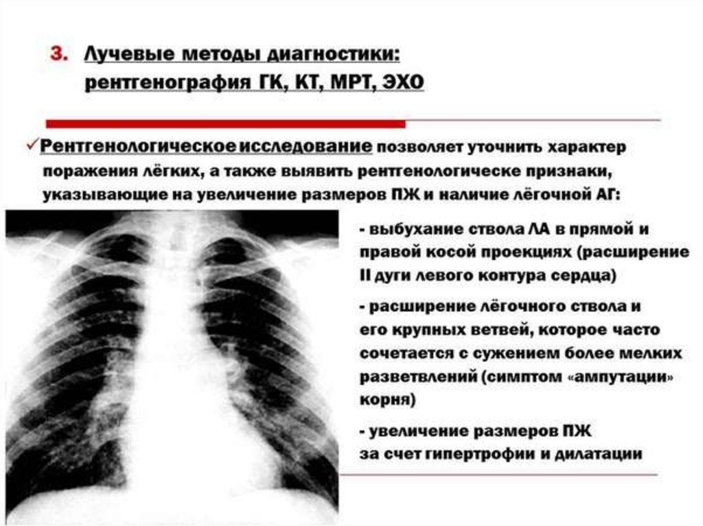 Лучевой диагноз. Расширение ствола легочной артерии на рентгене. Легочная гипертензия рентген признаки. Рентген легких при легочной гипертензии. Легочное сердце рентген.