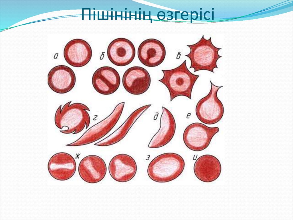 Форма эритроцитов. Формы эритроцитов пойкилоцитоз. Эритроциты шизоциты. Нормальные и патологические формы эритроцитов. Атипичные формы эритроцитов.