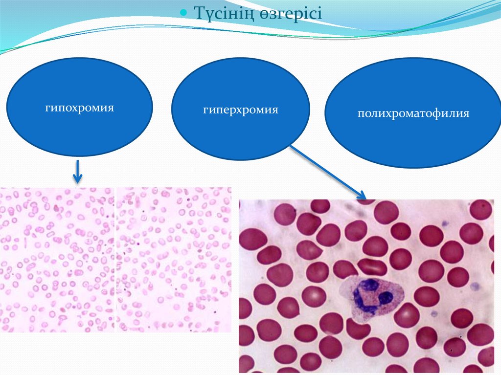 Гипохромия. Гипохромия и гиперхромия. Гиперхромия макроцитоз. Гипохромия и гиперхромия эритроцитов.