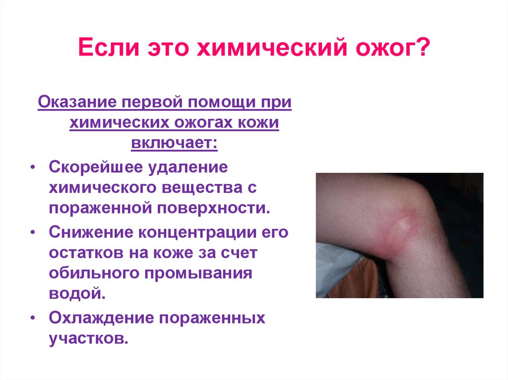 Если это химический ожог?