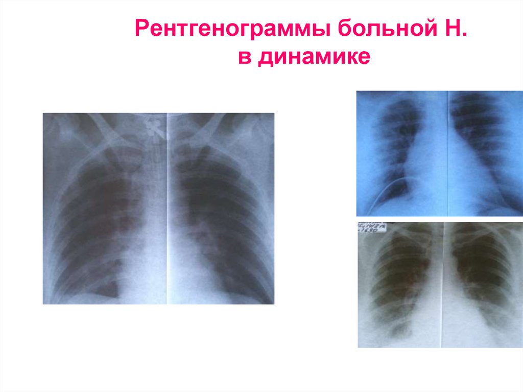 Рентгенограммы больной Н. в динамике
