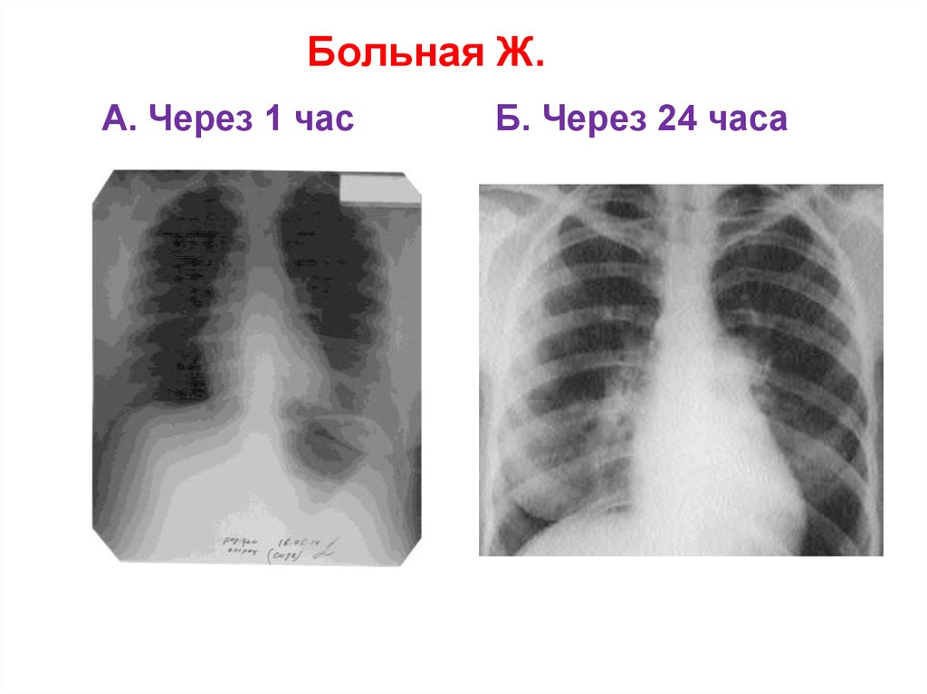 Больная Ж. А. Через 1 час Б. Через 24 часа