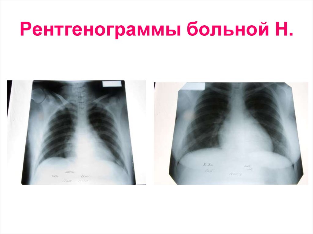 Рентгенограммы больной Н.