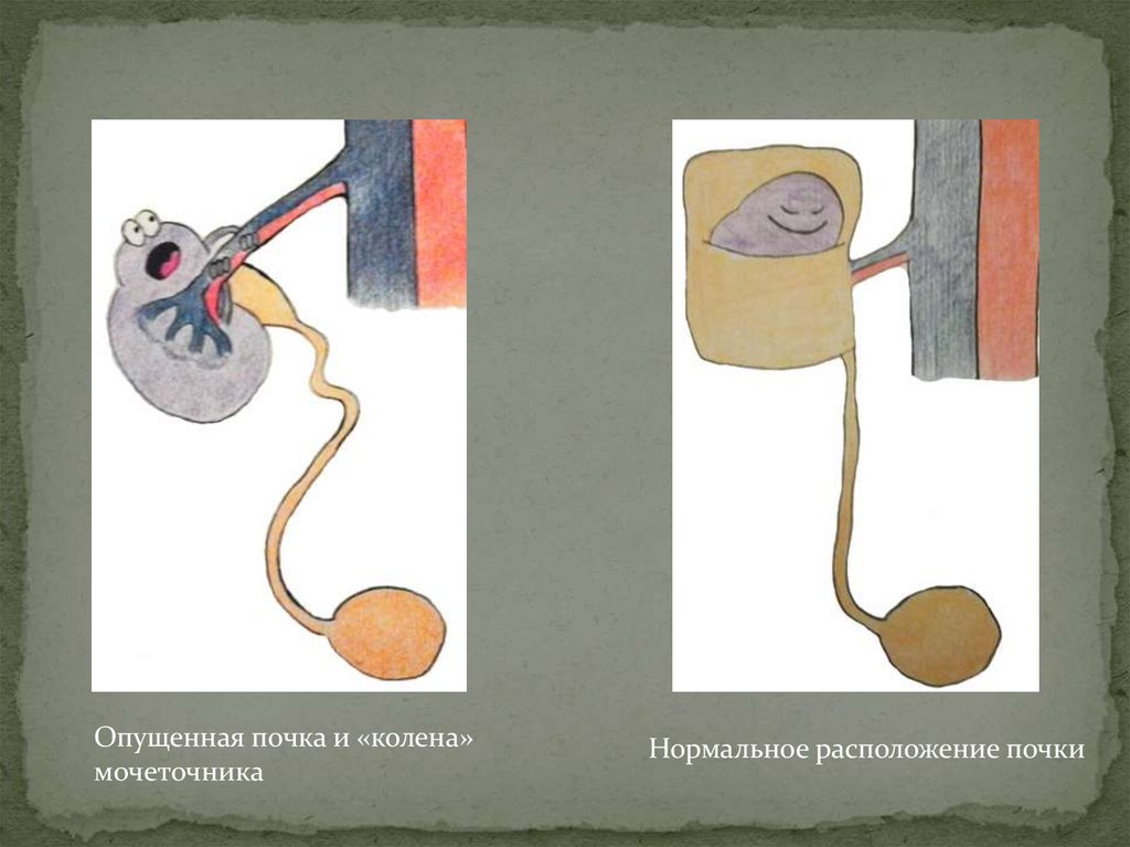 Что означает термин плавающая почка. Могут ли опуститься почки. Опущенная почка симптомы.