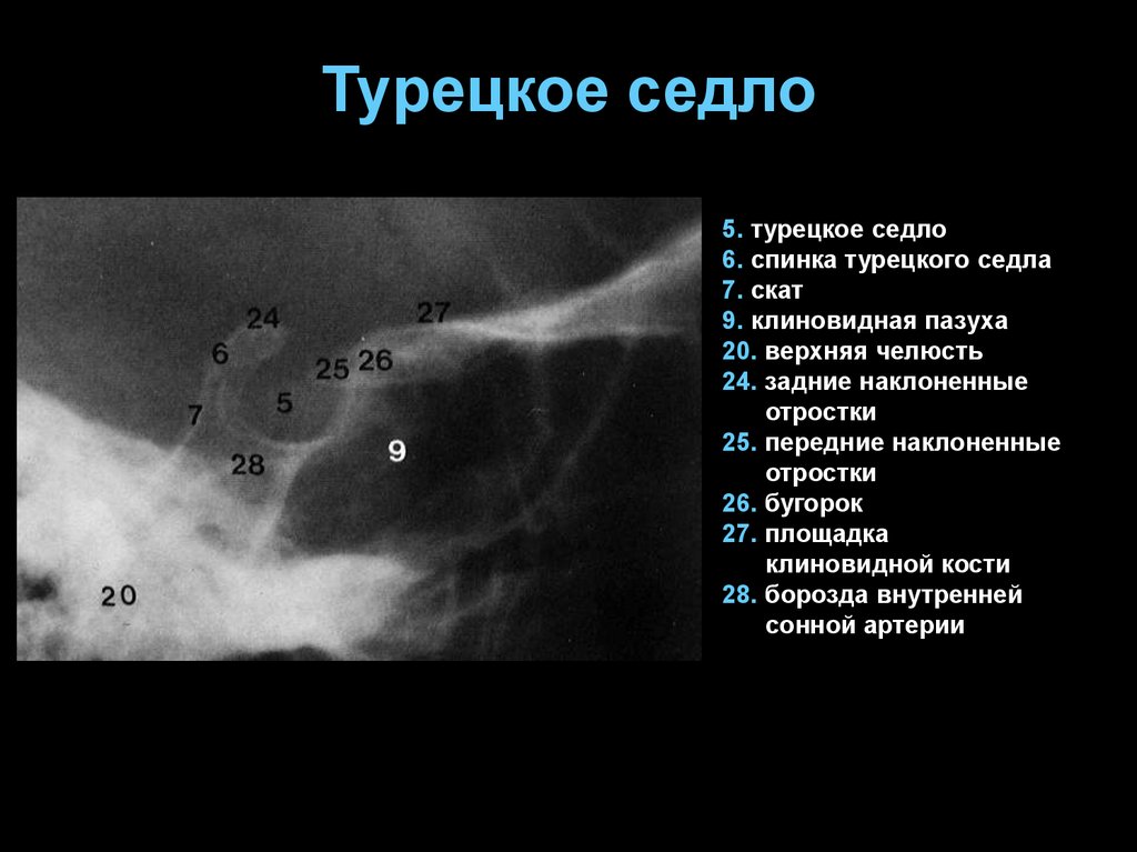 Мозг седло. Турецкое седло рентген анатомия. Турецкое седло рентген норма. Остеопороз спинки турецкого седла рентген. Турецкое седло рентген описание.