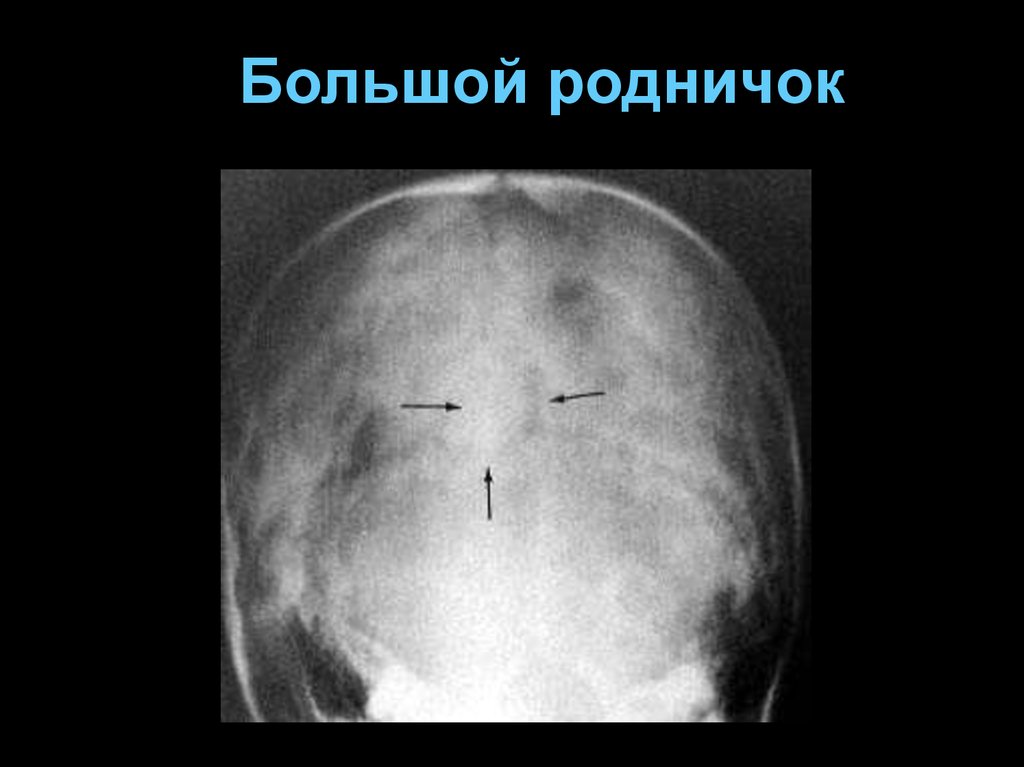 Измерение родничка. Рентгеноанатомия костей черепа. Большой Родничок. Рентген головы новорожденного Родничок. Измерение большого родничка.
