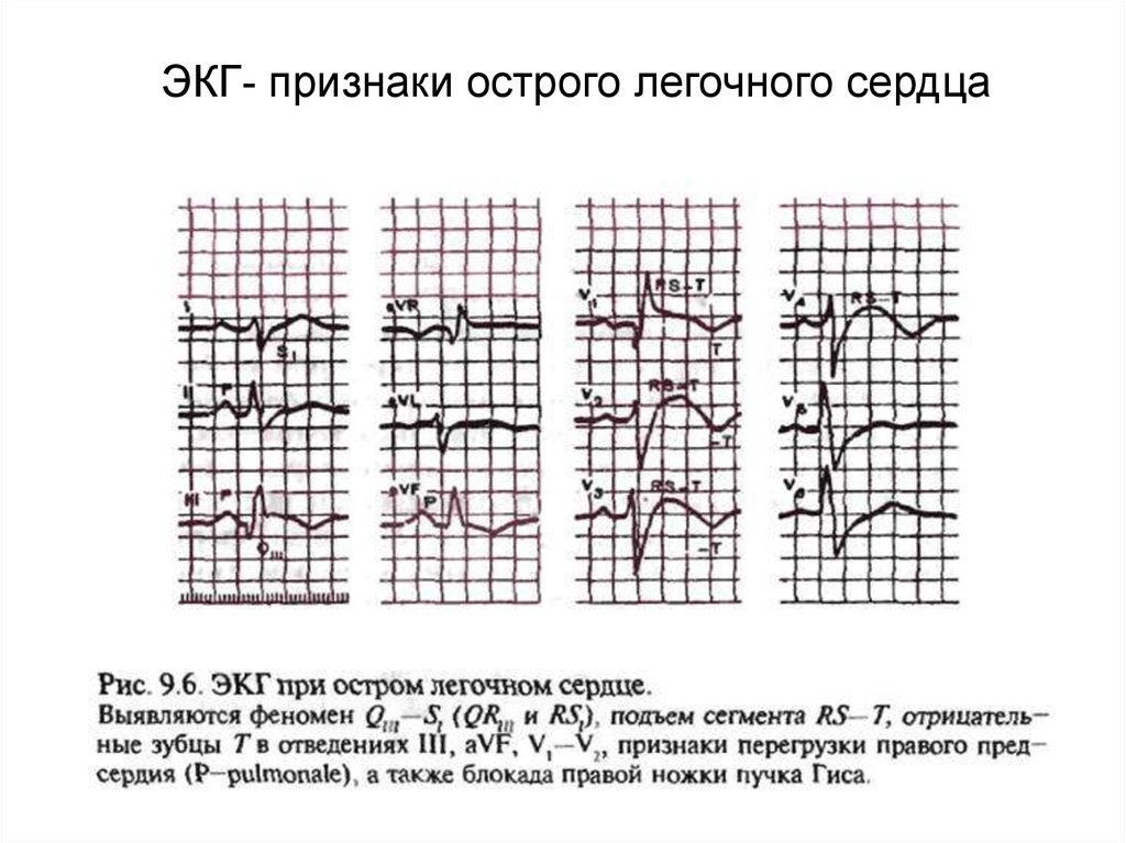 Тэла экг картина